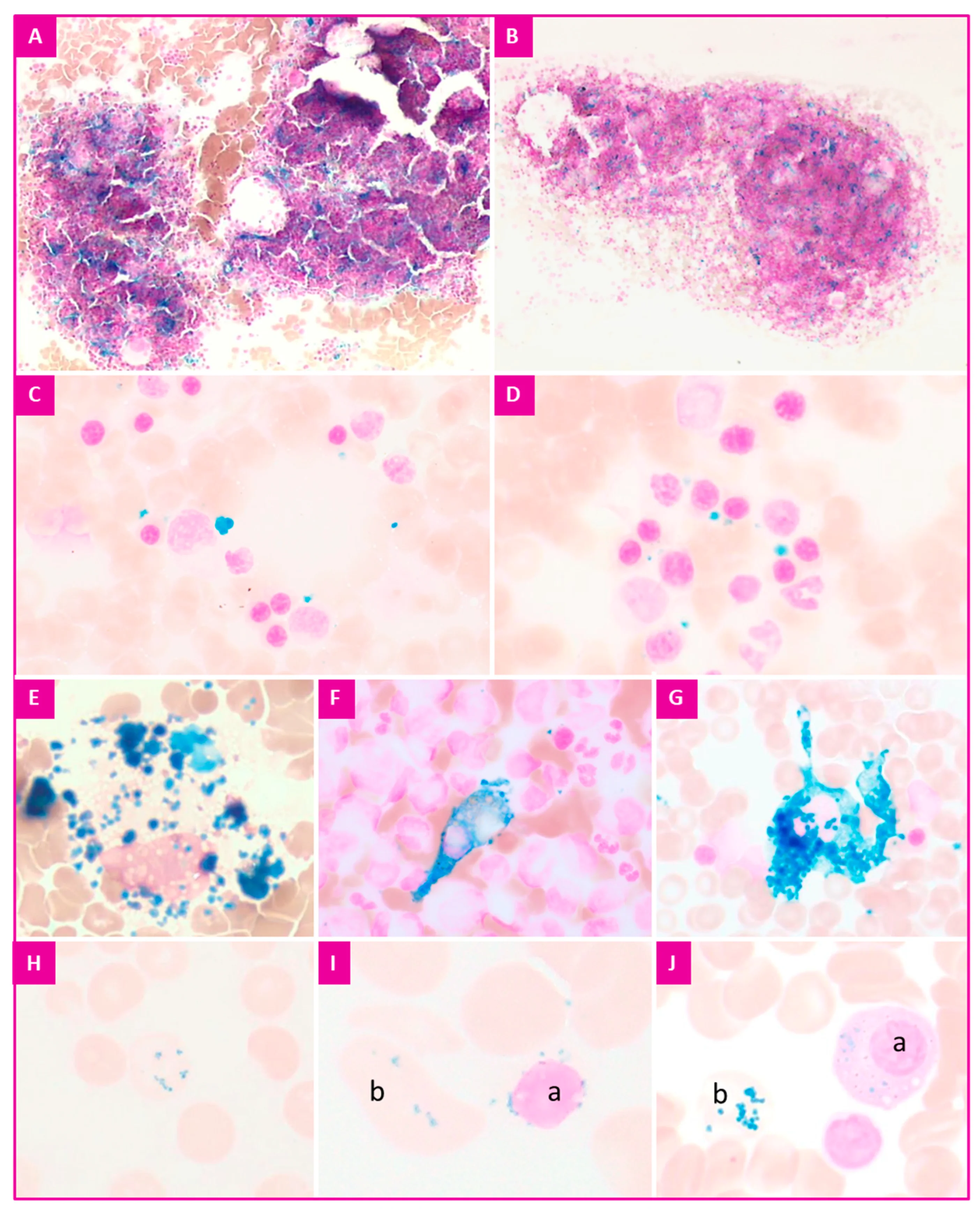 조직검사학 · Figure 2. Prussian blue reaction of erythroid precursors, hematoxylin counterstain. (A,B) medullar iron content evaluation; (C,D) extracellular iron deposits; (E–G) macrophages; (H) siderocyte