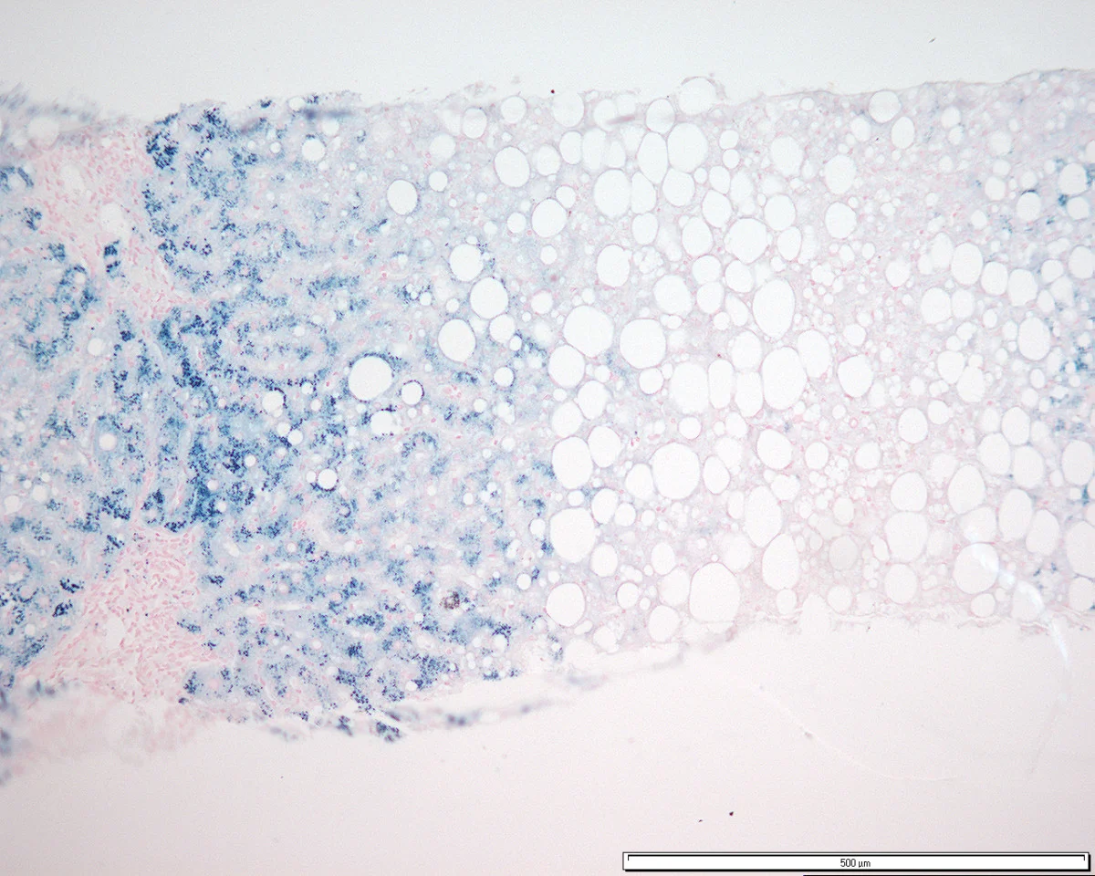 조직검사학 · Grade 3 hepatocyte iron accumulation with an acinar distribution pattern consistent with homozygous genetic hemochromatosis. (Perl's Prussian Blue: ×10).