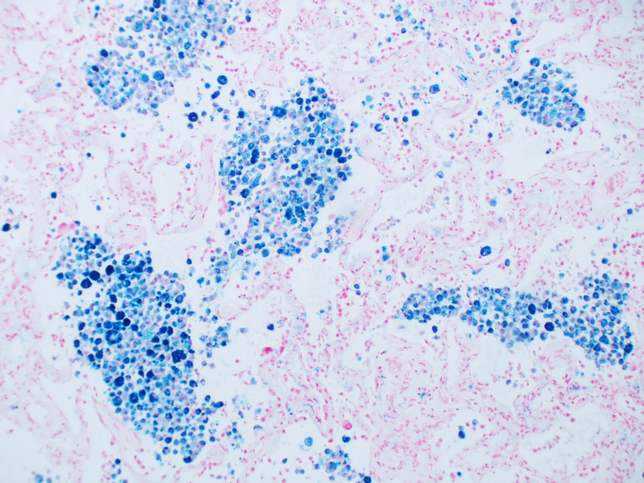 조직검사학 · Intra-alveolar hemosiderin deposition Extensive Intra-alveolar hemosiderin deposition following pulmonary hemorrhage. Prussian blue stain. Pulmonary veno-occlusive disease.