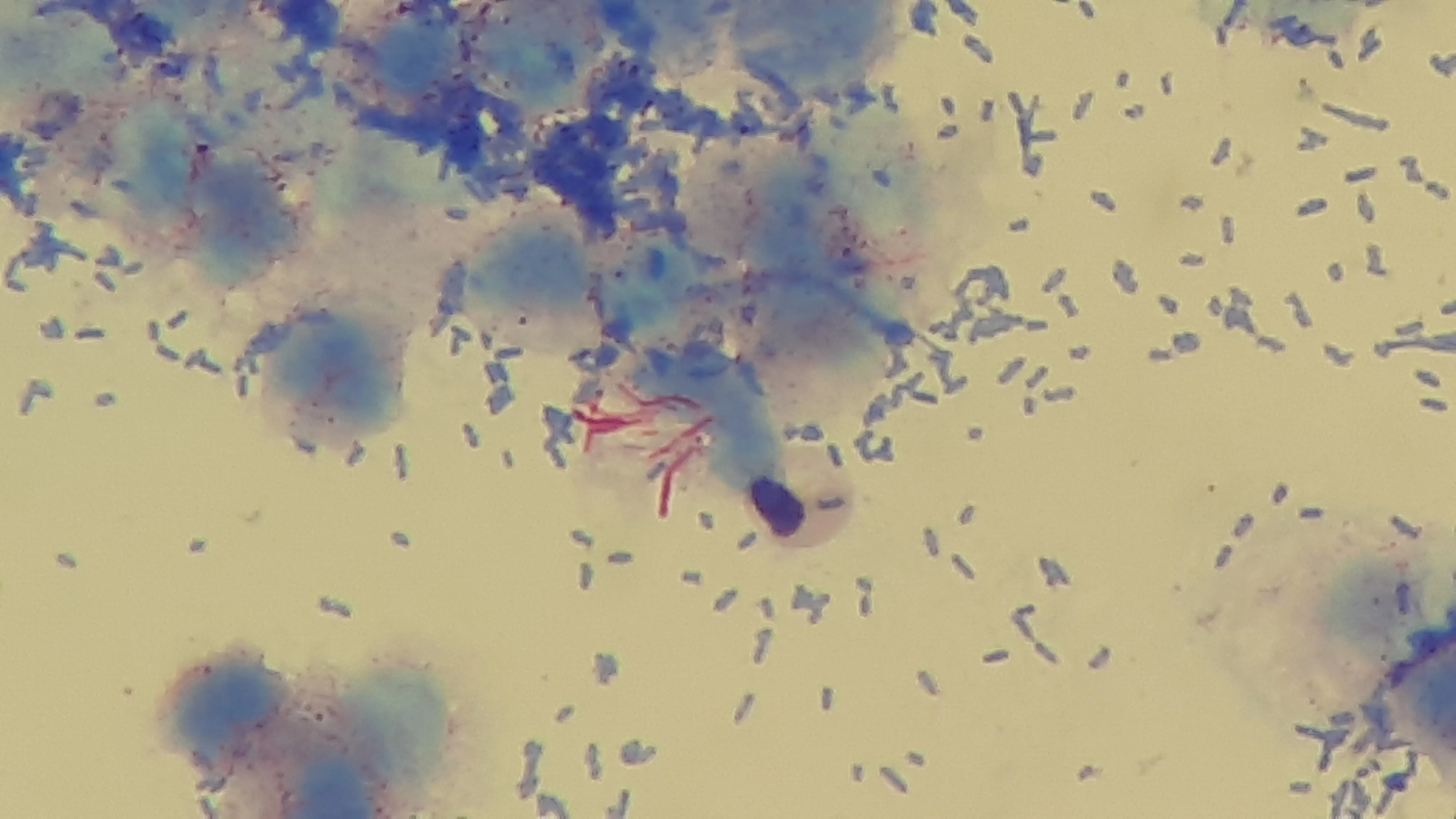 조직검사학 · Acid fast bacilli (AF) of M. tuberculosis in acid -fast staining of urine sediment microscopy