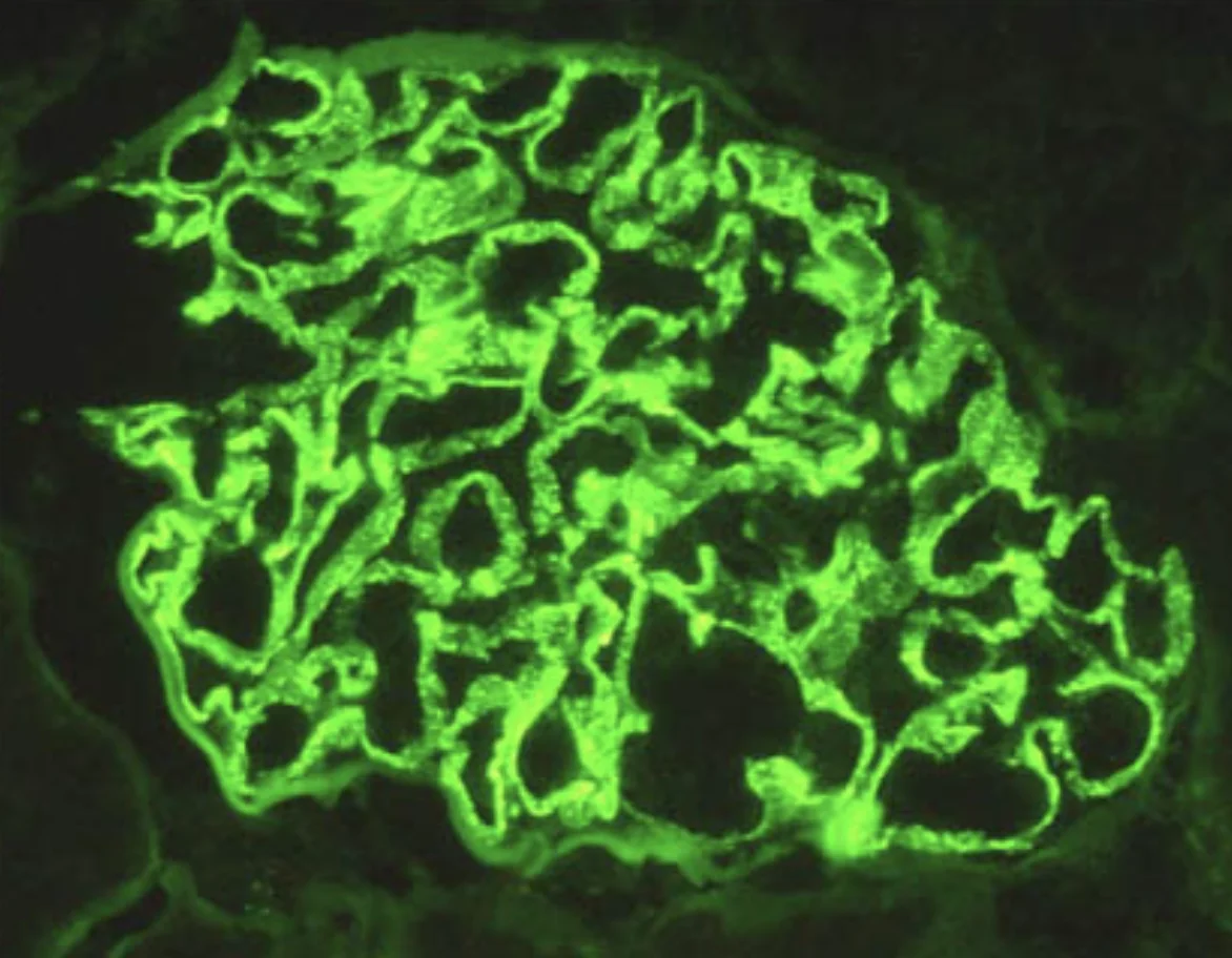 조직검사학 · Immunofluorescence image of a renal glomerulus demonstrating bright green linear to granular staining along the glomerular basement membranes, consistent with immune complex or antibody deposi