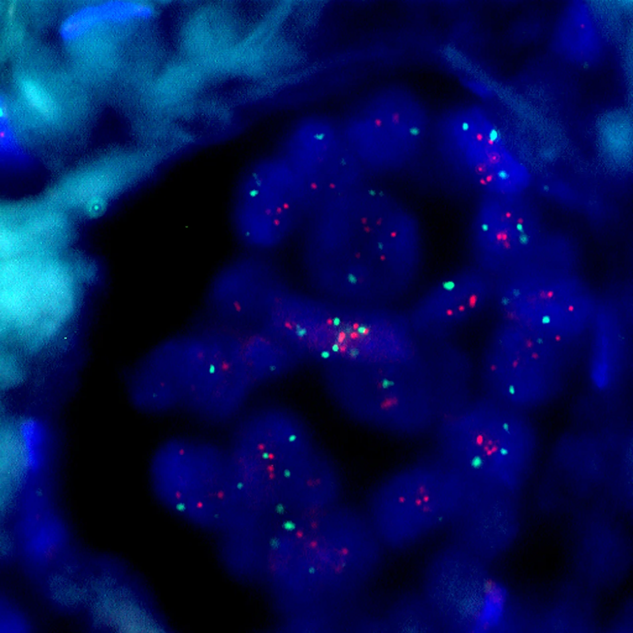 조직검사학 · Her2 gene amplification by FISH (fluorescent in situ hybridization) in breast cancer cells
