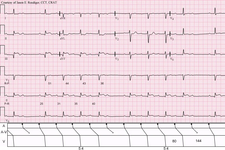  · Sinus rhythm with acute inferior infarction complicated by Type II A-V block manifest in the form of 5:4 Wenckebach periods; R-P/P-R reciprocity.