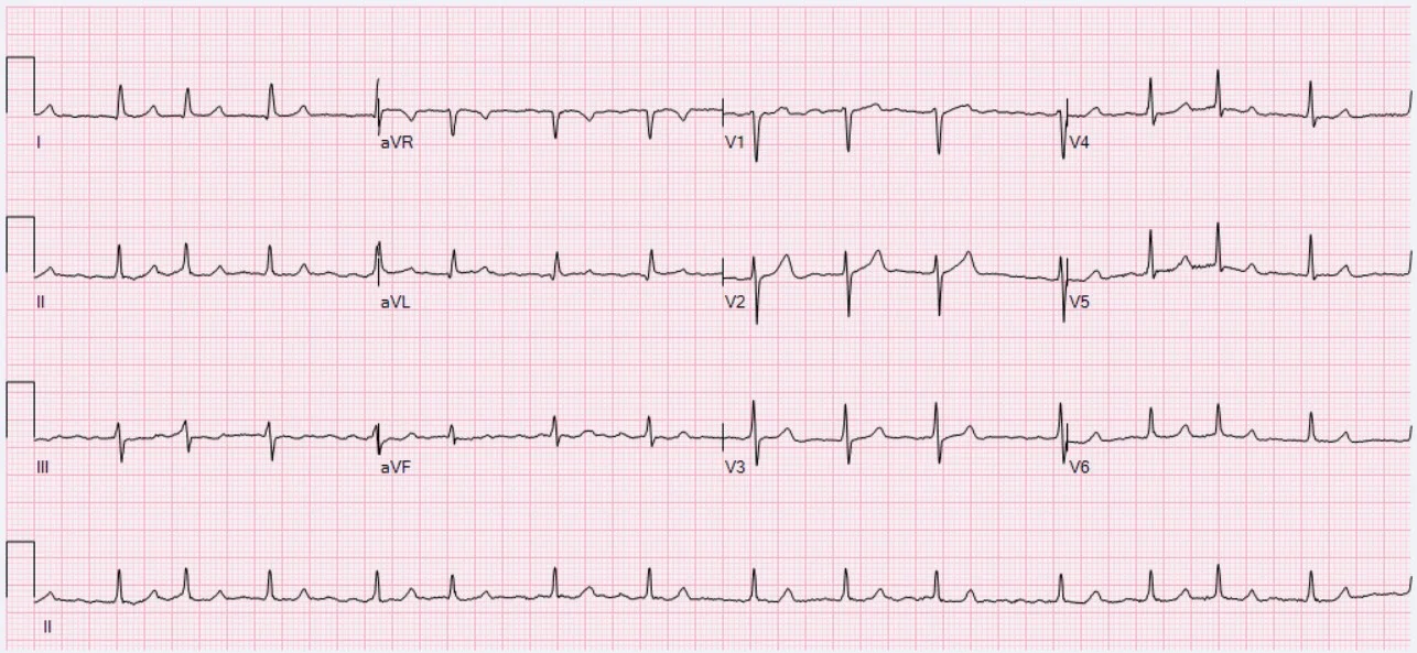  · ECG of a 54-year-old male with atrial fibrillation and controlled ventricular response. Heart rate 90 bpm, QT/QTc 348/425 ms