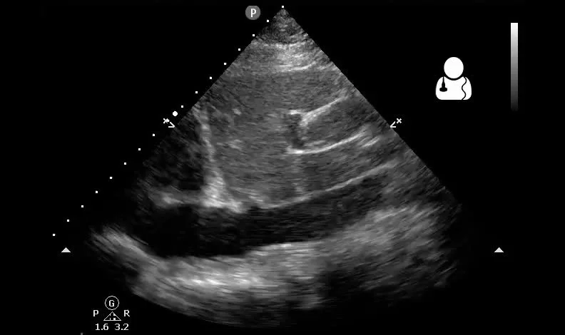  · :62 year old male presents with a history of HIV and chronic pericardial effusion presents with several days of worsening dizziness, shortness of breath and near syncope. Vitals: 142 75/35 24 98.4 