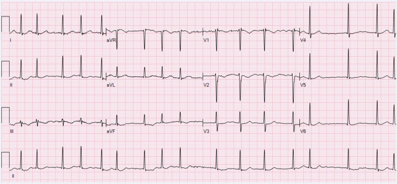  · ECG of an 89-year-old female with atrial fibrillation and controlled ventricular response. Heart rate 98 bpm, QT/QTc 342/4436 ms