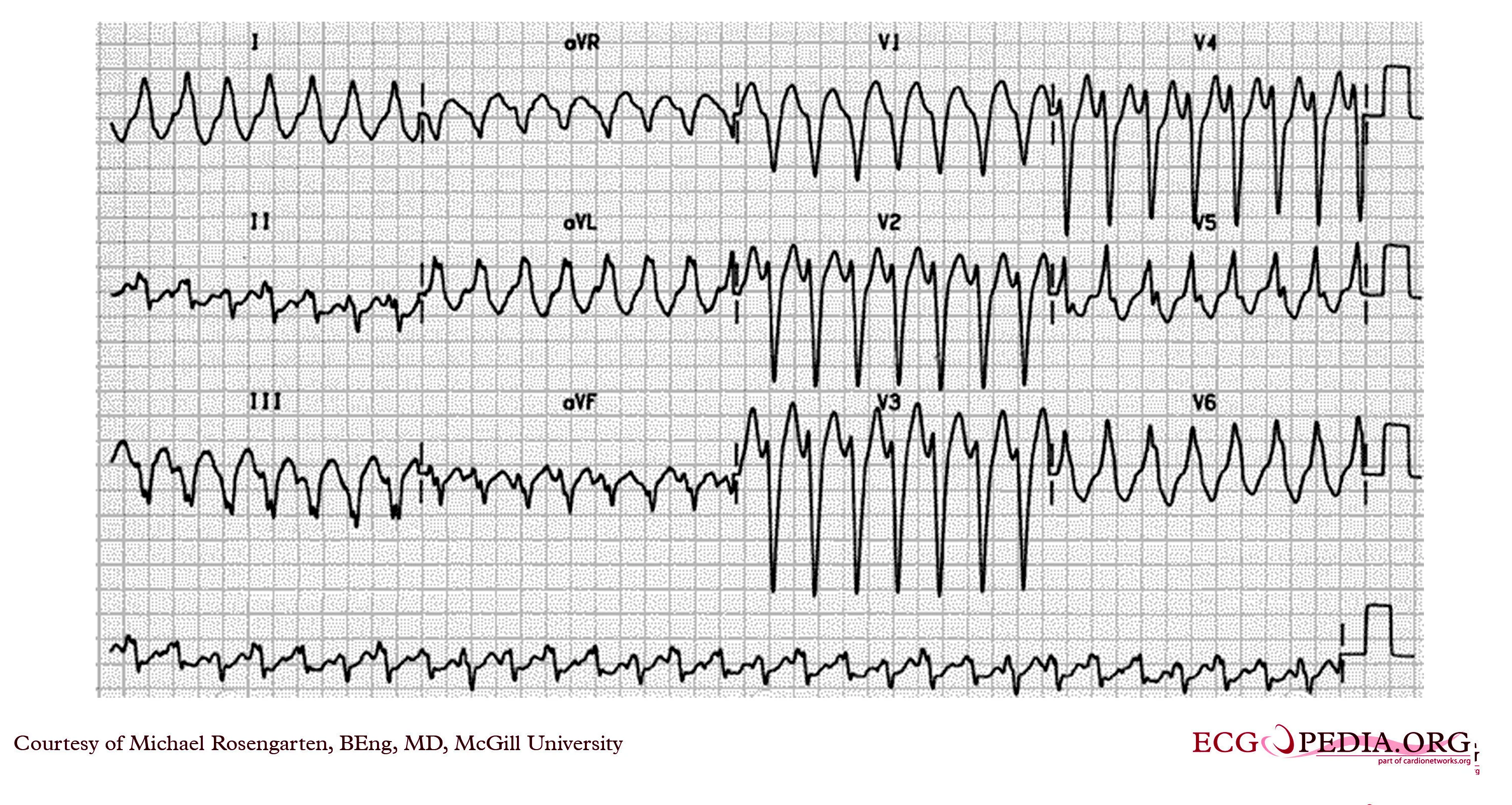 · This is an electrocardiogram from an elderly woman with palpitations. The cardiogram shows a wide complex tachycardia with a left bundle branch morphology at a rate of about 160/min. The R wave in 
