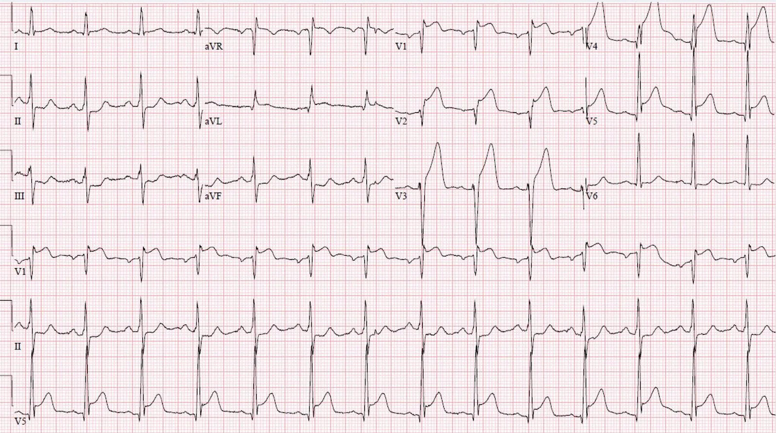  · Electrocardiogram at presentation demonstrating ST elevation myocardial infarction in the anterior leads
