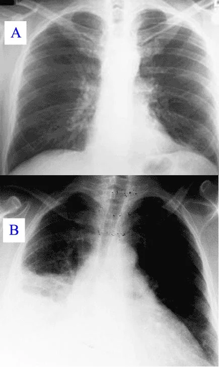 chest x-ray pneumonia — Pneumonia x-ray