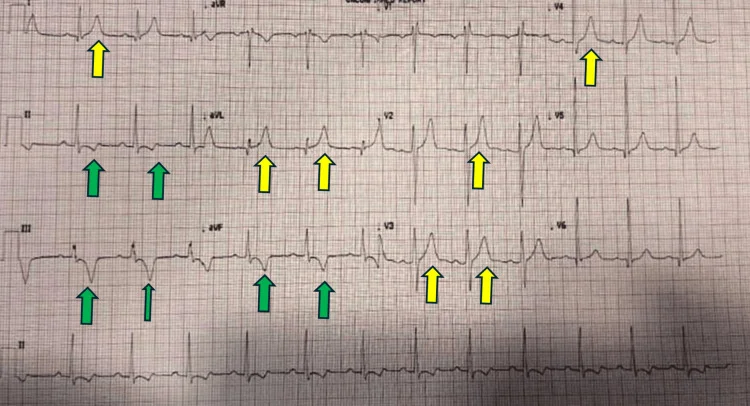 normal electrocardiogram — Electrocardiogram post-ablation showing normal sinus rhythm