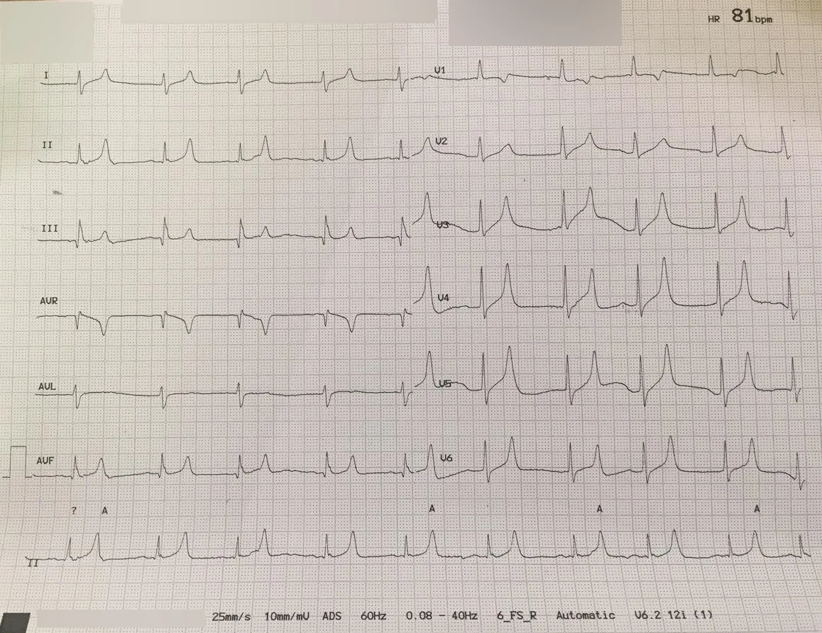 hyperkalemia ECG peaked T waves — Hyperkalemia ECG