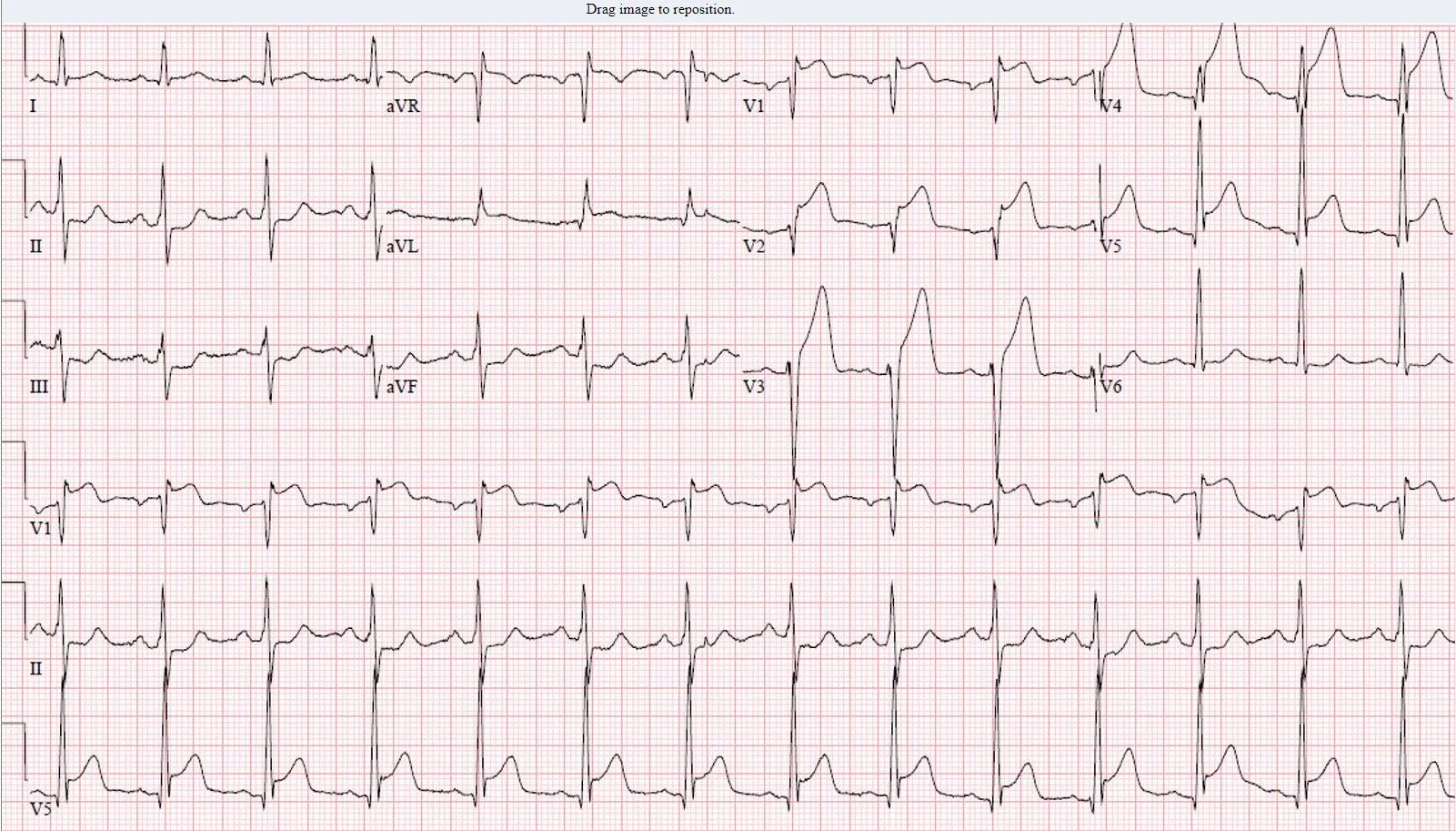 ST elevation myocardial infarction ECG — ST elevation myocardial infarction ECG