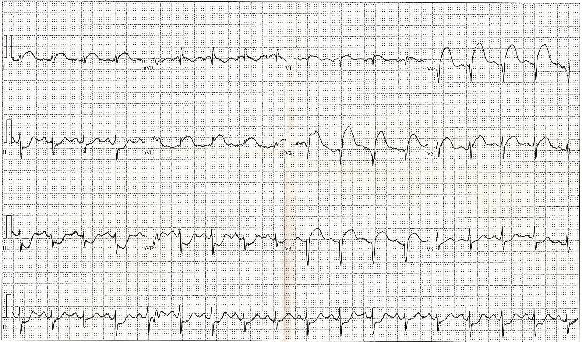 ST elevation myocardial infarction ECG — 12 Lead EKG ST Elevation tracing only