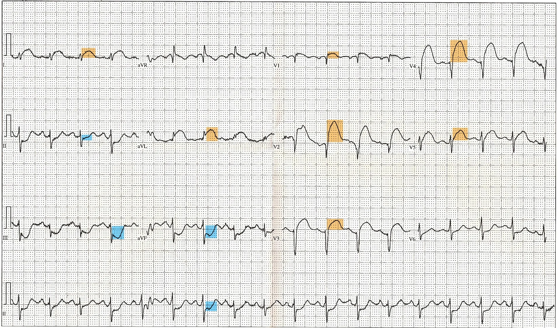 ST elevation myocardial infarction ECG — 12 Lead EKG ST Elevation tracing color coded