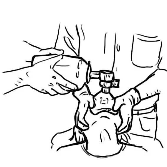 Two-person bag valve mask ventilation
