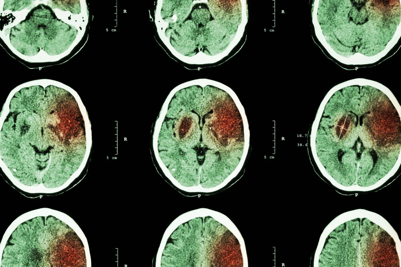 Brain CT scan used for rapid stroke evaluation