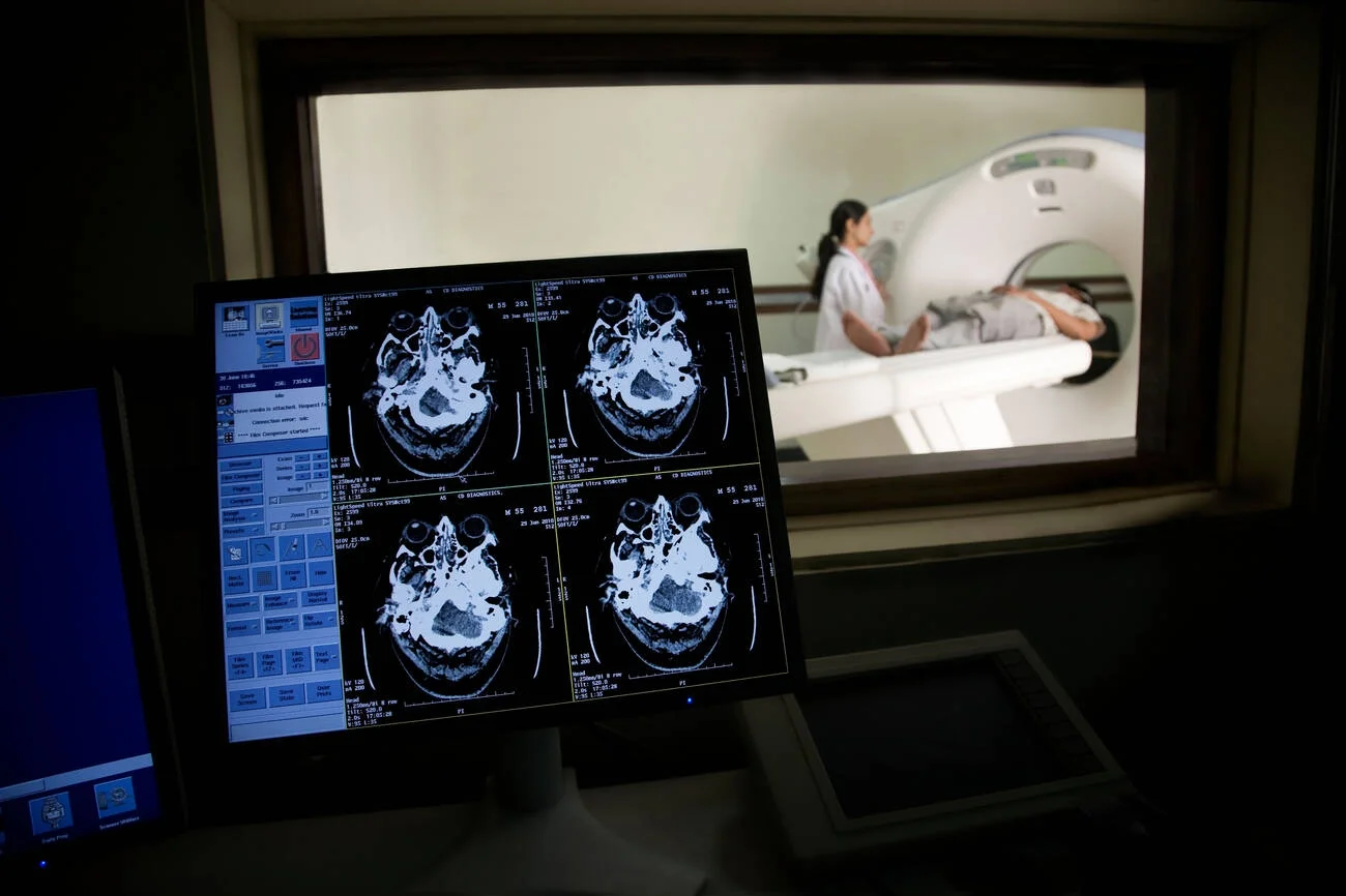stroke CT scan — CT Brain Scan