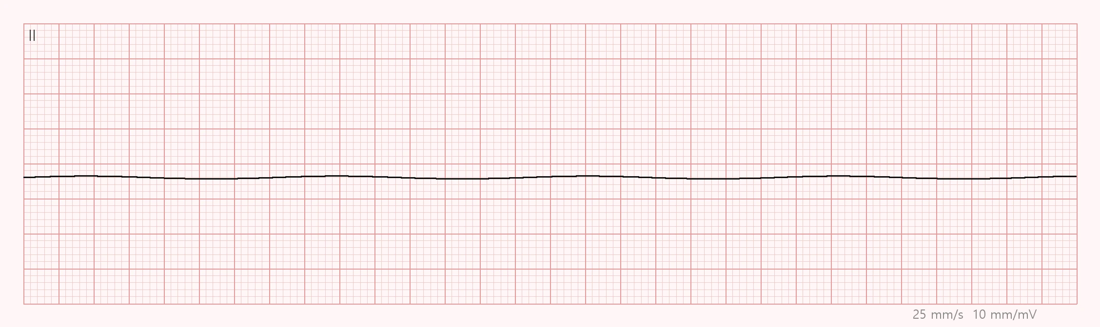 전문응급처치학각론 · 무수축(Asystole) (심전도)