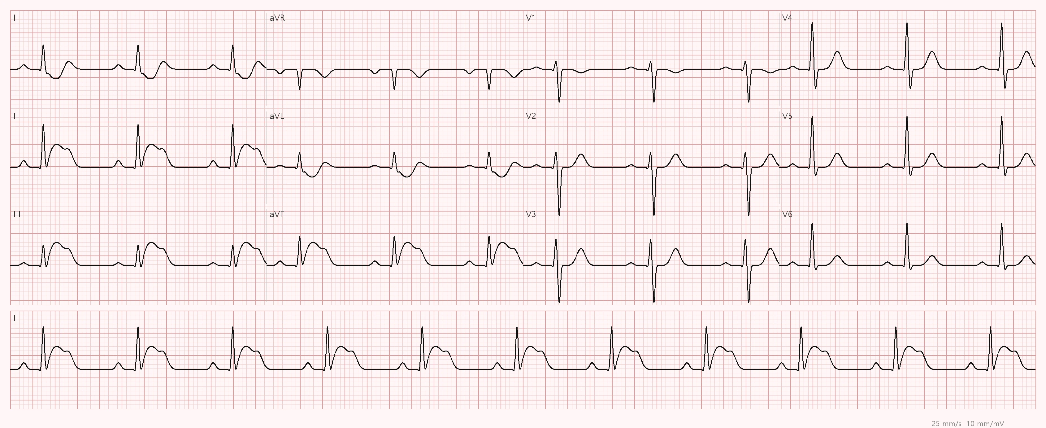 전문응급처치학각론 · STEMI-하벽 (12유도심전도)