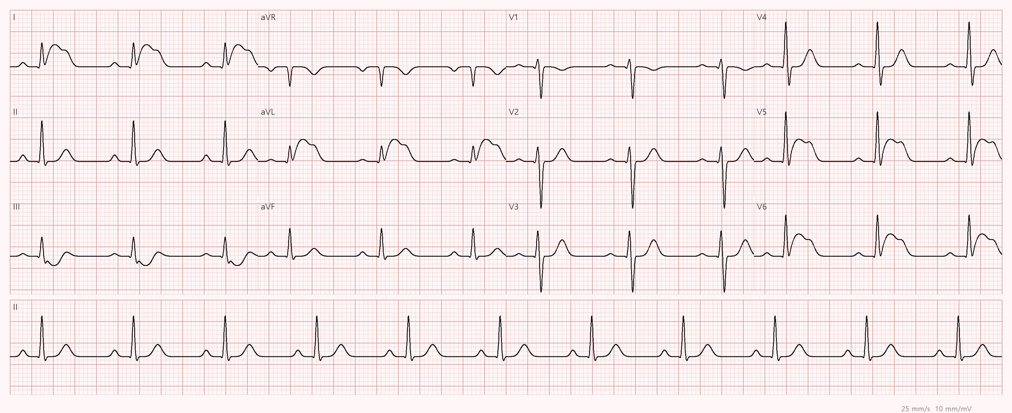 전문응급처치학각론 · STEMI-측벽 (12유도심전도)