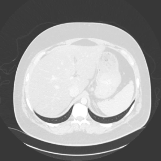 복부 CT 폐 창