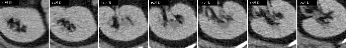 콩팥 병변 연속 장