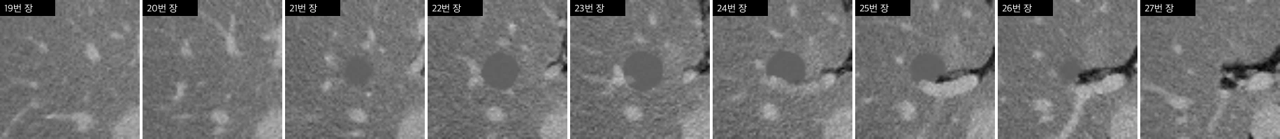 간 병변 연속 장