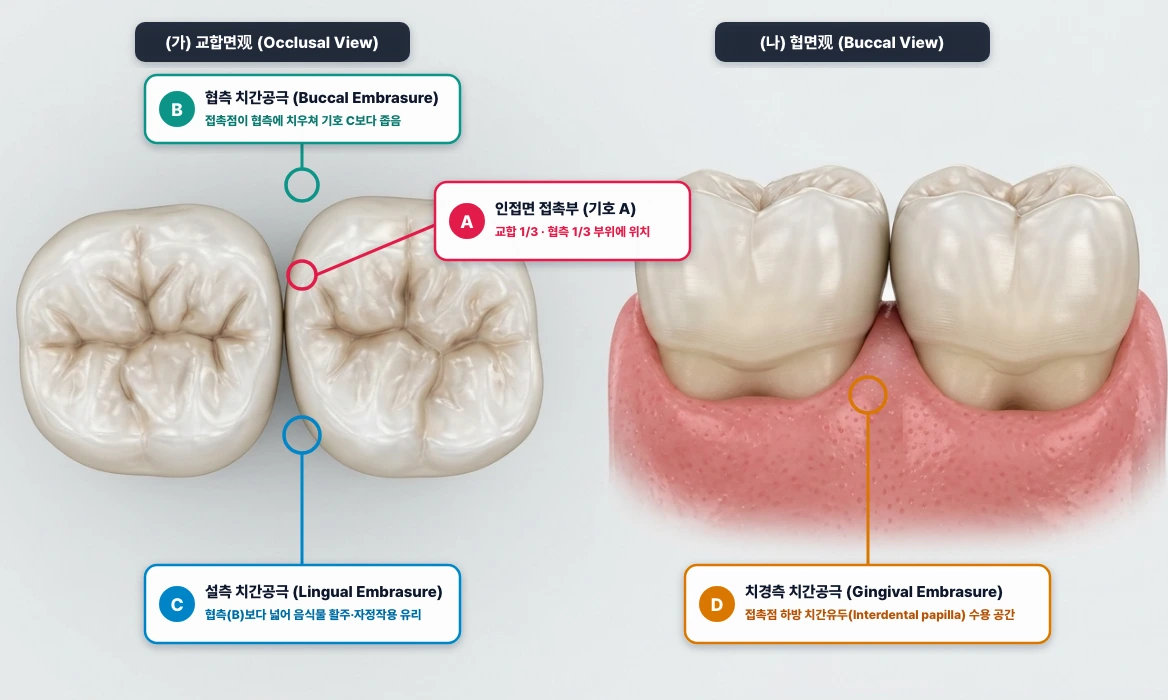 구치부 인접면 접촉부(Contact area) 위치 및 4대 치간공극(협측·설측·교합측·치경측 Embrasure)