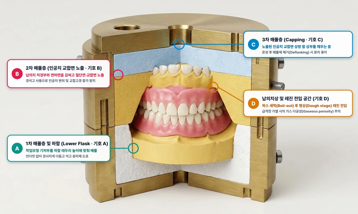 총의치 압축 성형용 함(Flask)의 3단계 분할 매몰(1차·2차·3차) 및 레진 전입·온성 단면