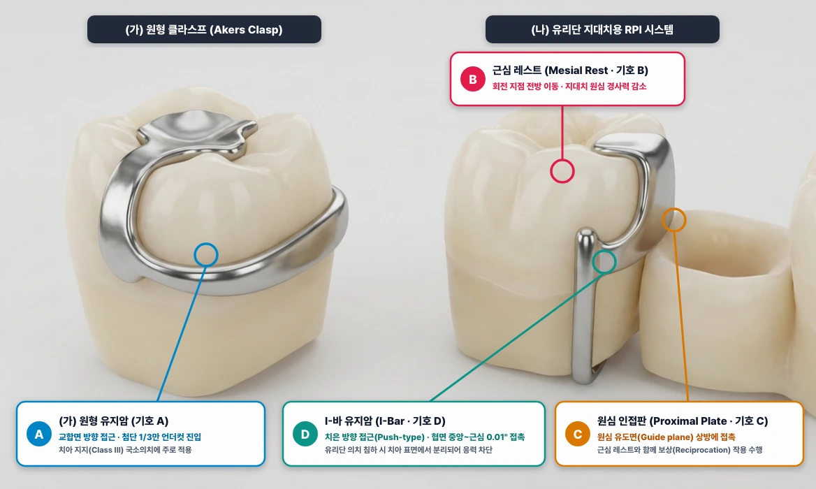 국소의치 직접유지장치 비교: 원형 클라스프(Akers) vs 유리단 지대치용 바형 RPI 클라스프