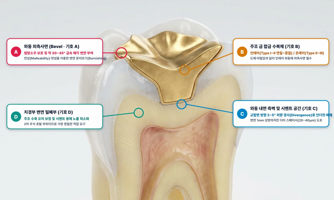 주조 금 인레이·온레이(Cast Gold Inlay/Onlay) 와동 외측사면(Bevel) 및 변연 적합 단면