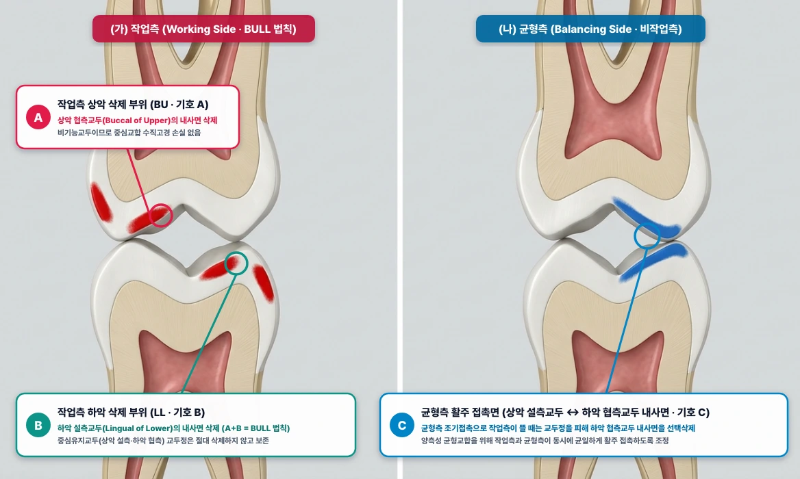 총의치 측방 운동 시 양측성 균형교합을 위한 선택삭제(Selective Grinding): (가) 작업측 BULL 법칙 vs (나) 균형측