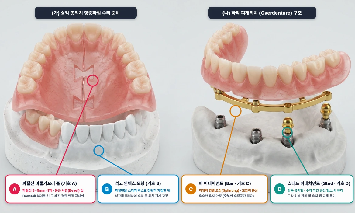 총의치 정중파절 비둘기꼬리(Dovetail) 수리(가) 및 임플란트/치근 지지 피개의치 어태치먼트(나)