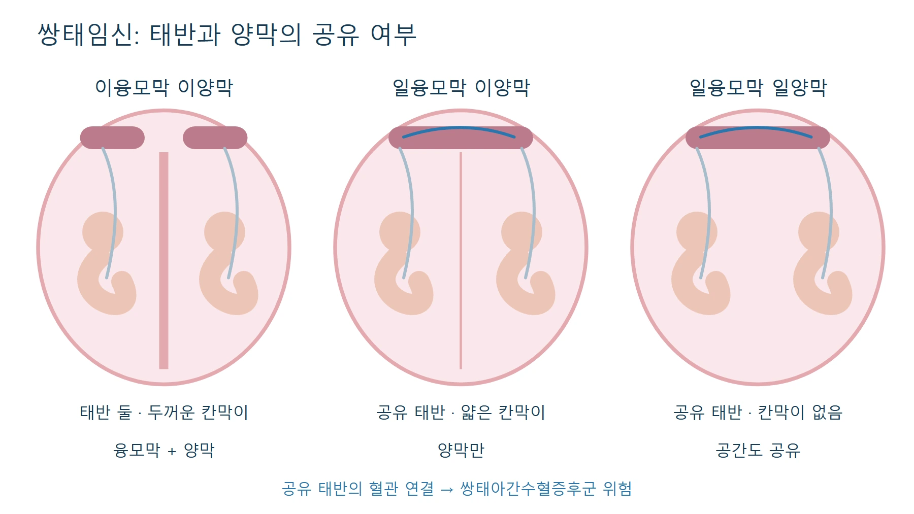 쌍태임신의 태반과 양막 — 이융모막 이양막, 일융모막 이양막, 일융모막 일양막, 융모막, 양막, 공유 태반, 혈관 연결(쌍태아간수혈증후군)