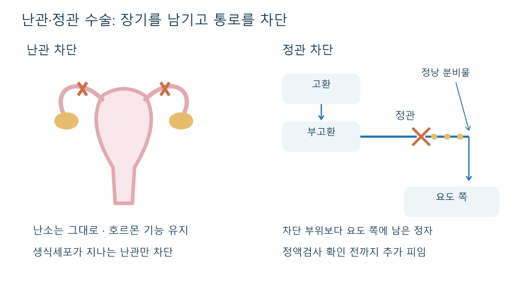 난관·정관 차단 — 난관 차단, 난소 그대로(호르몬 유지), 정관 차단, 고환 그대로, 차단 위쪽에 남은 정자, 정액검사로 확인 후 피임 중단