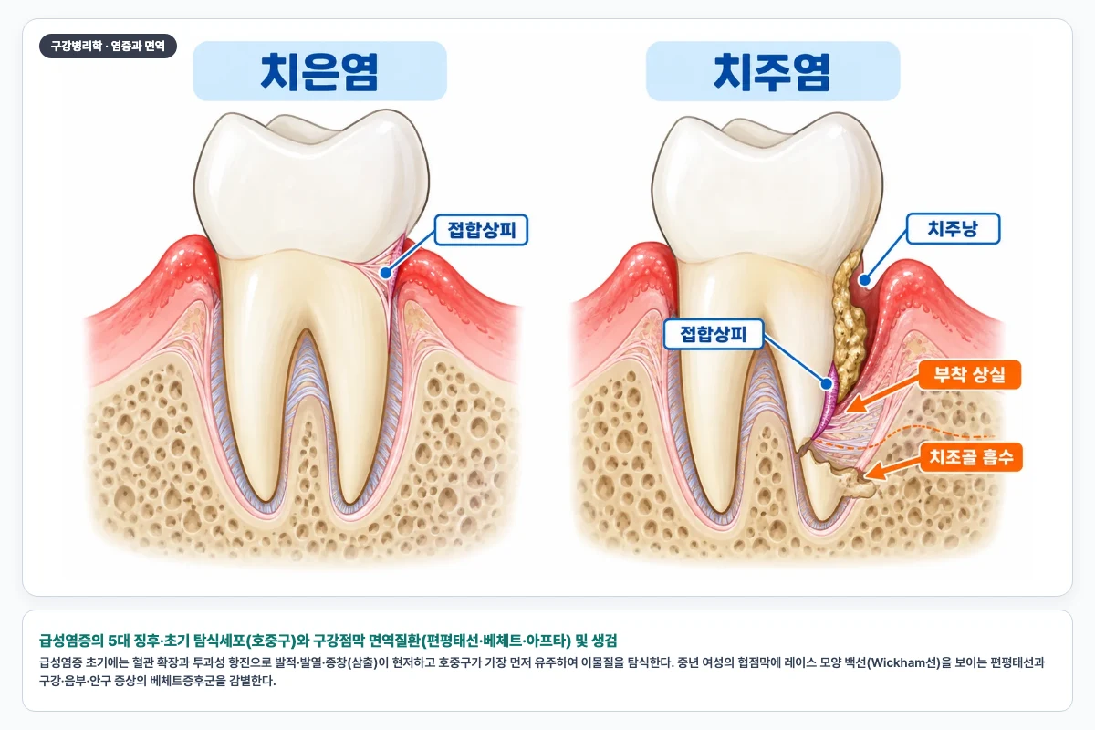 급성염증의 5대 징후·초기 탐식세포(호중구)와 구강점막 면역질환(편평태선·베체트·아프타) 및 생검