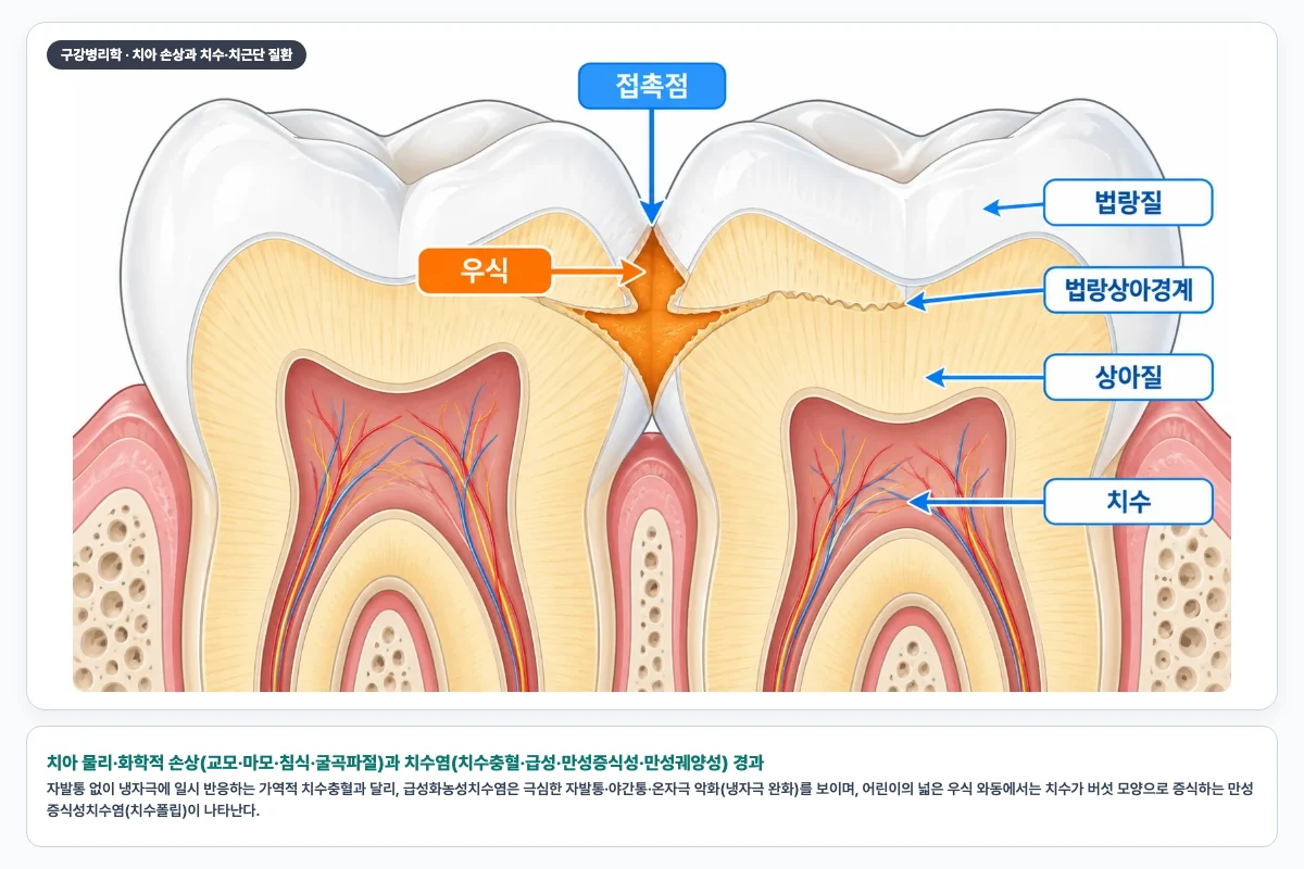 치아 물리·화학적 손상(교모·마모·침식·굴곡파절)과 치수염(치수충혈·급성·만성증식성·만성궤양성) 경과