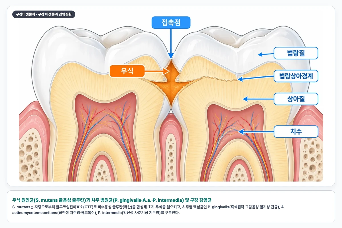 우식 원인균(S. mutans 불용성 글루칸)과 치주 병원균(P. gingivalis·A.a.·P. intermedia) 및 구강 감염균