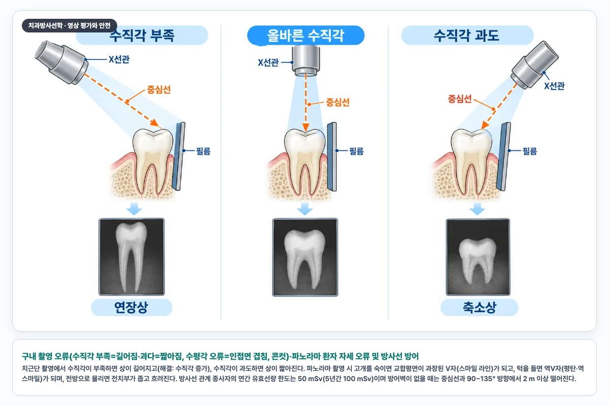 구내 촬영 오류(수직각 부족=길어짐·과다=짧아짐, 수평각 오류=인접면 겹침, 콘컷)·파노라마 환자 자세 오류 및 방사선 방어