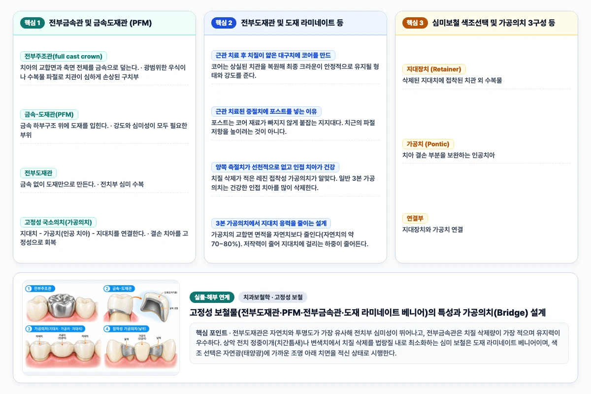 치과보철학 고정성 보철 핵심 비교 및 단계별 기전 도해