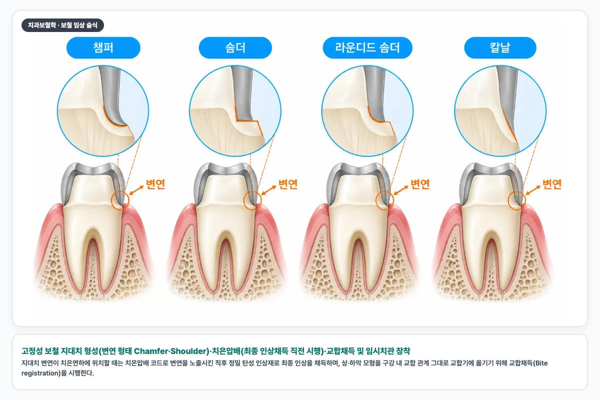 고정성 보철 지대치 형성(변연 형태 Chamfer·Shoulder)·치은압배(최종 인상채득 직전 시행)·교합채득 및 임시치관 장착