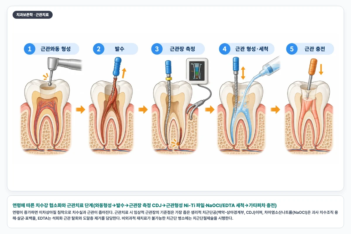 연령에 따른 치수강 협소화와 근관치료 단계(와동형성→발수→근관장 측정 CDJ→근관형성 Ni-Ti 파일·NaOCl/EDTA 세척→가타퍼차 충전)
