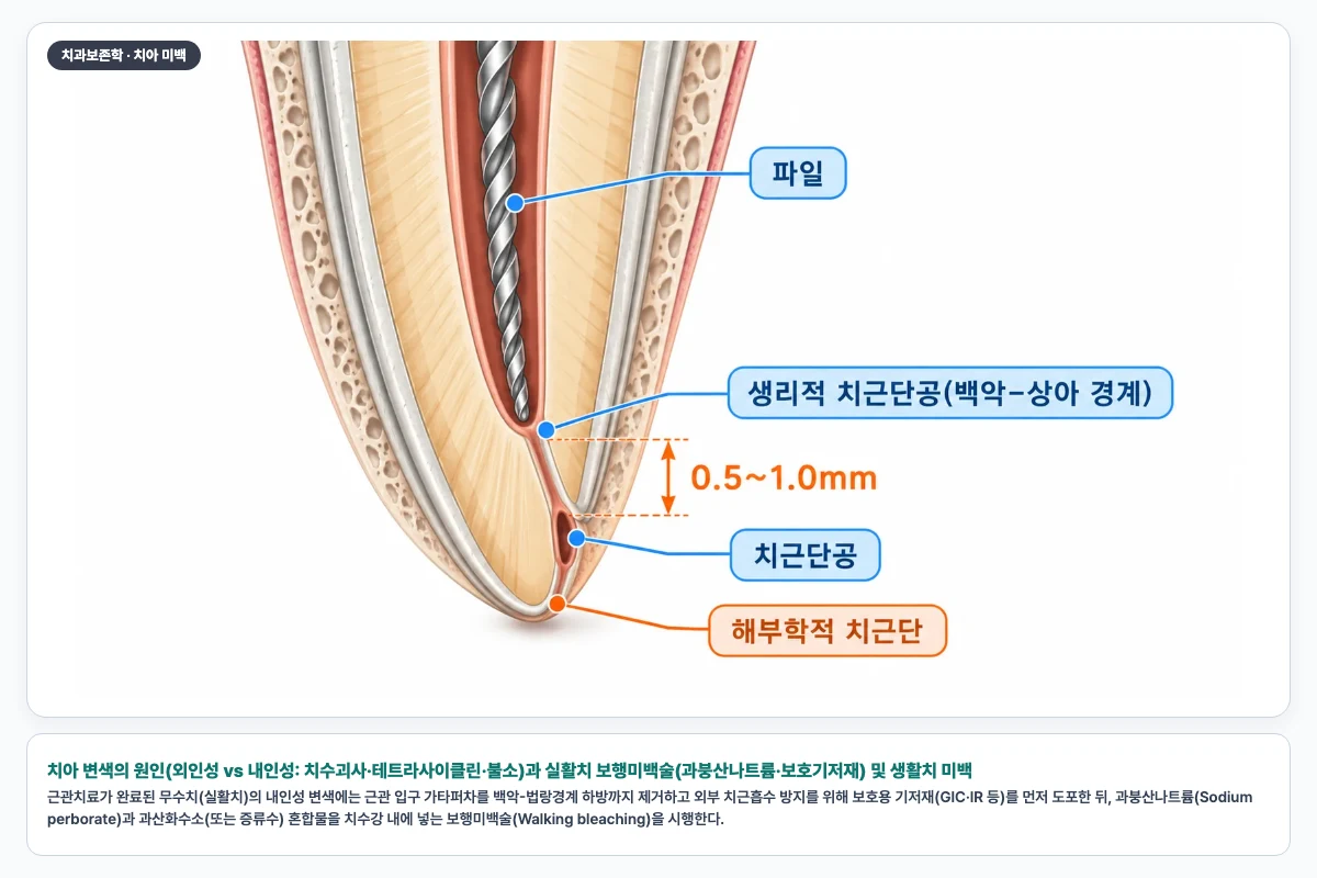 치아 변색의 원인(외인성 vs 내인성: 치수괴사·테트라사이클린·불소)과 실활치 보행미백술(과붕산나트륨·보호기저재) 및 생활치 미백