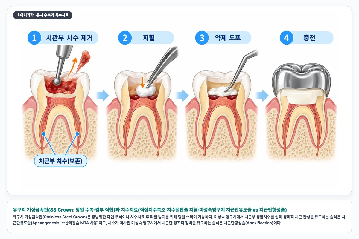 유구치 기성금속관(SS Crown: 당일 수복·경부 적합)과 치수치료(직접치수복조·치수절단술 지혈·미성숙영구치 치근단유도술 vs 치근단형성술)