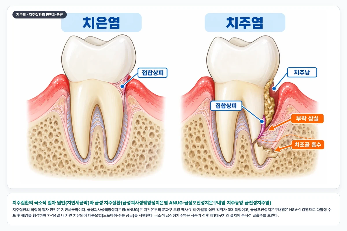 치주질환의 국소적 일차 원인(치면세균막)과 급성 치주질환(급성괴사성궤양성치은염 ANUG·급성포진성치은구내염·치주농양·급진성치주염)