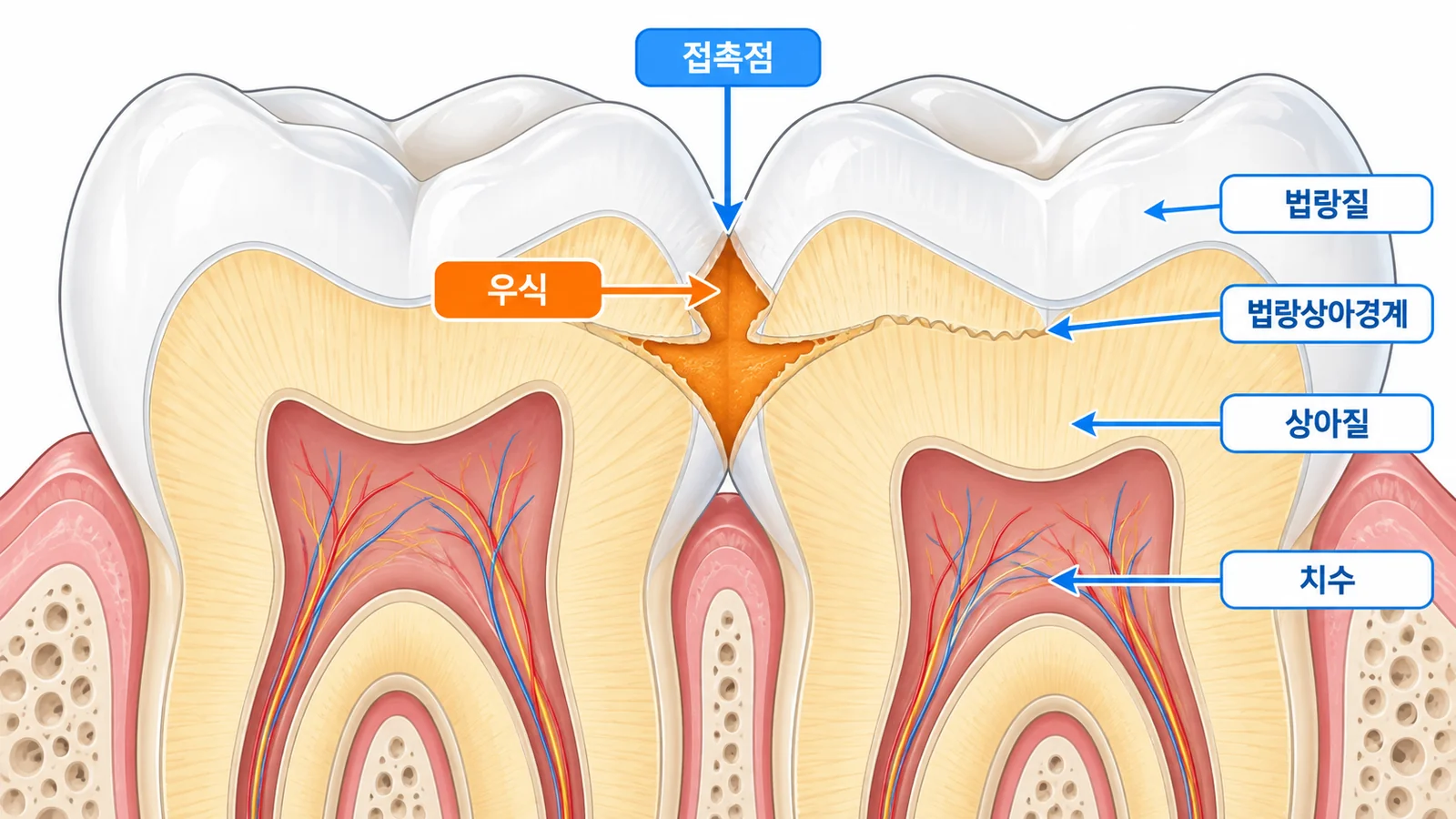 인접면 우식의 진행