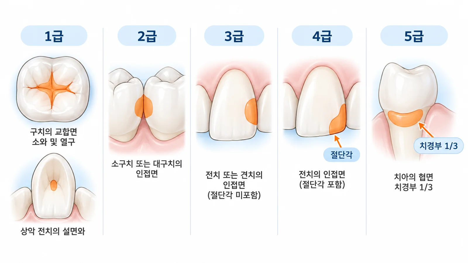 Black의 와동 분류 1~5급