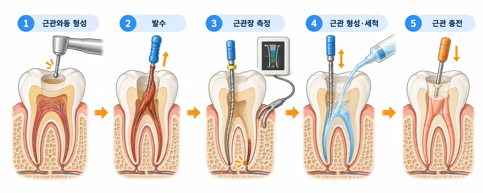 근관치료 순서