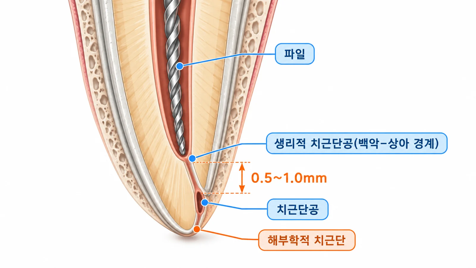 해부학적 치근단과 생리적 치근단공