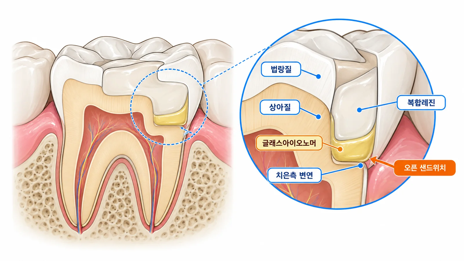 2급 와동의 오픈 샌드위치